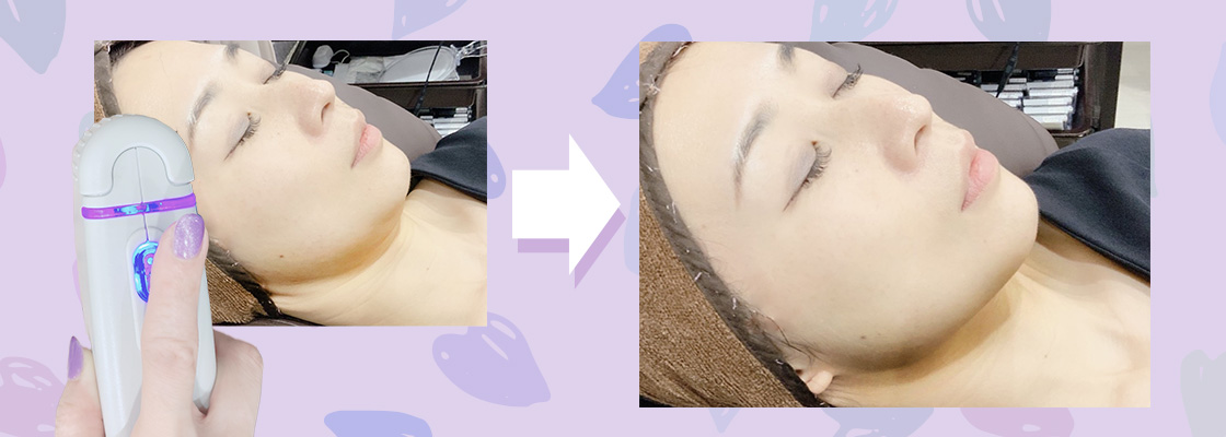 前立腺がんに対するHIFU治療はどの程度安全で効果的ですか?